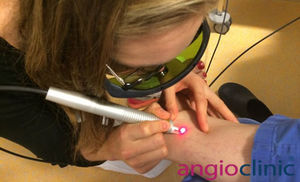 Besenreiser-Behandlung mit dem Laser