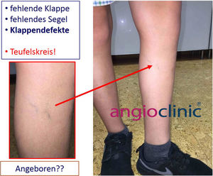 Krampfadern Kontrolluntersuchungen
